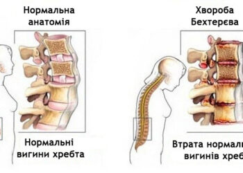 Однією з причин болю у хребті може бути так звана хвороба Бехтерєва, або анкілозивний спондиліт. Фото: akademia-gracia.com