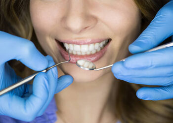 На стан зубів безпосередньо впливають особливості та міцність зубної емалі, гіповітамінози, спадковість, екологія, якість води, гормональні збої, особливо у жінок тощо. Фото: pixabay.com