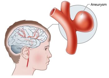 Якщо стався розрив аневризми дрібної судини у голові, тоді у людини виникає геморагічний інсульт, тобто крововилив у мозок. Фото: unimed.zp.ua