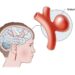 Якщо стався розрив аневризми дрібної судини у голові, тоді у людини виникає геморагічний інсульт, тобто крововилив у мозок. Фото: unimed.zp.ua