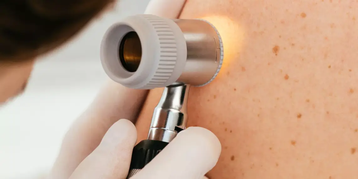 Небезпека полягає в тому, що деякі форми раку шкіри можуть маскуватися під звичайну папілому. Фото: esteva.com.ua