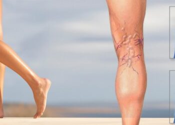 При варикозному розширенні кров у венах тече у зворотному напрямку. І це перешкоджає правильній циркуляції крові у ногах. Фото: biovitup.com