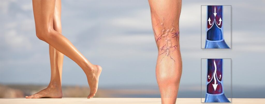 При варикозному розширенні кров у венах тече у зворотному напрямку. І це перешкоджає правильній циркуляції крові у ногах. Фото: biovitup.com